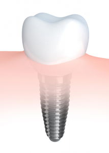 Are Dental implants worth it 214x300