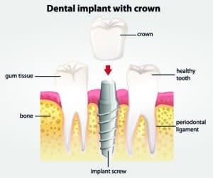Can my dental implants