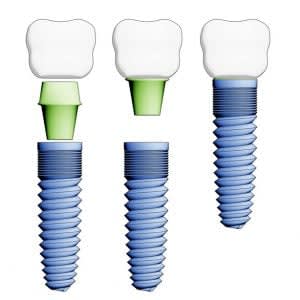Dental Implant F 300x300
