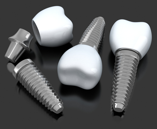 Dental Implants 3 Step
