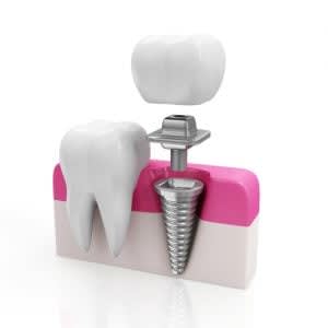 Dental Implants High Tech Teeth 300x300