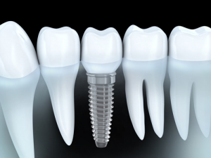 Dental Implants What to Expect 300x225