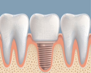 ImplantSuccess 300x240