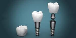 New Trends in Dental Implants 300x150