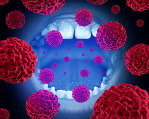 OropharyngealCancer 300x240
