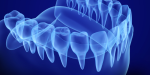 The Most Common Types Bone Grafting 300x150