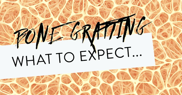 What to Expect When Expecting (..A Bone Graft)