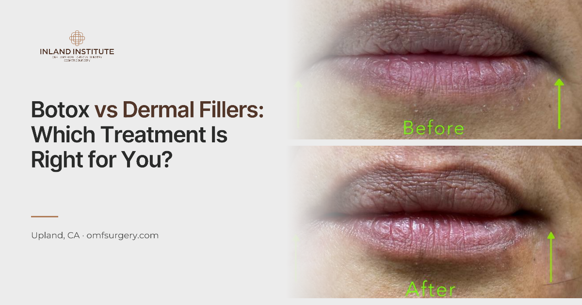 Lip dermal filler before and after results at Inland Institute in Upland, CA