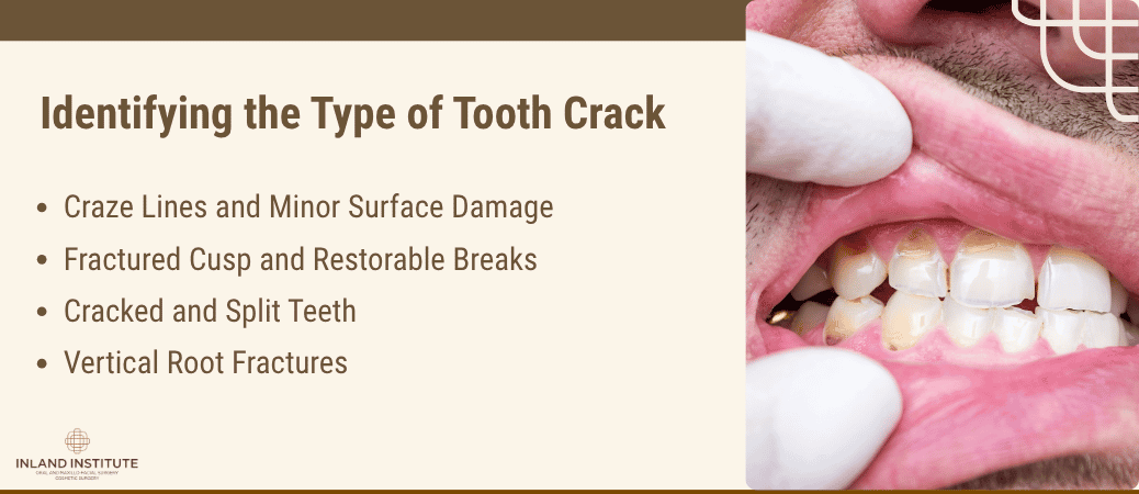 Types of tooth cracks: craze lines, fractured cusps, split teeth, and vertical root fractures