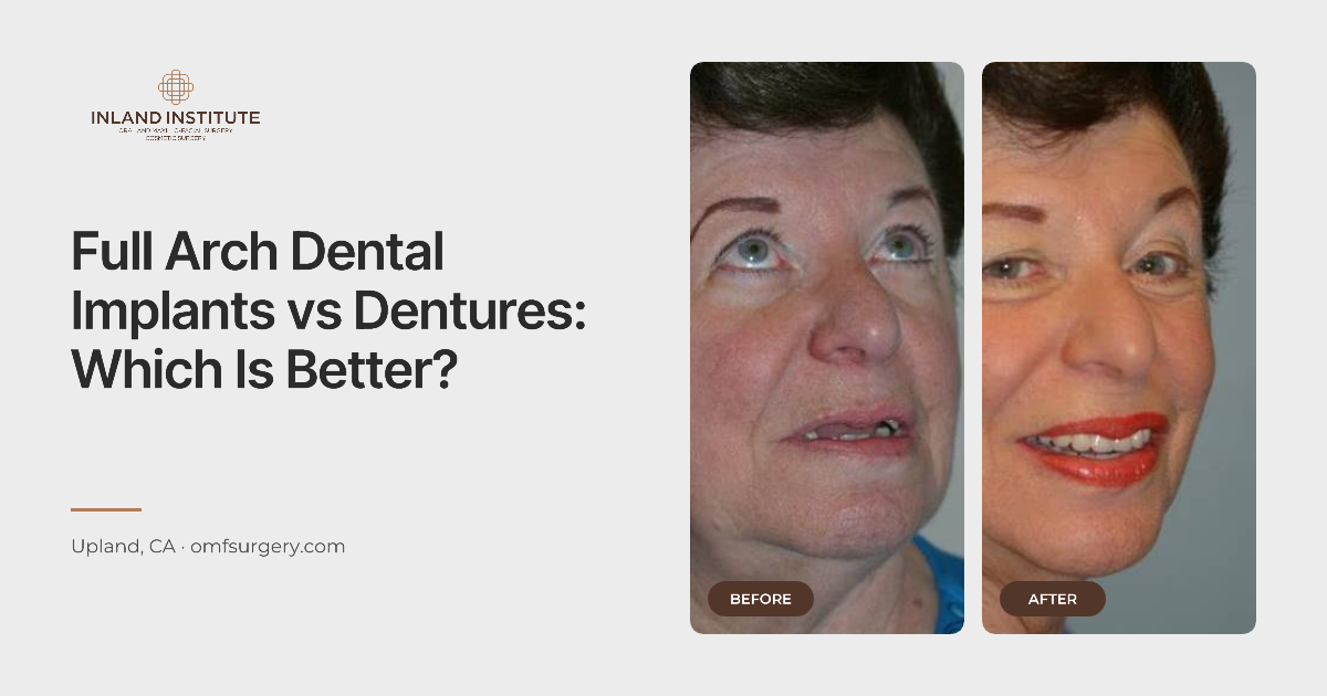 Full arch dental implants before and after results at Inland Institute in Upland, CA