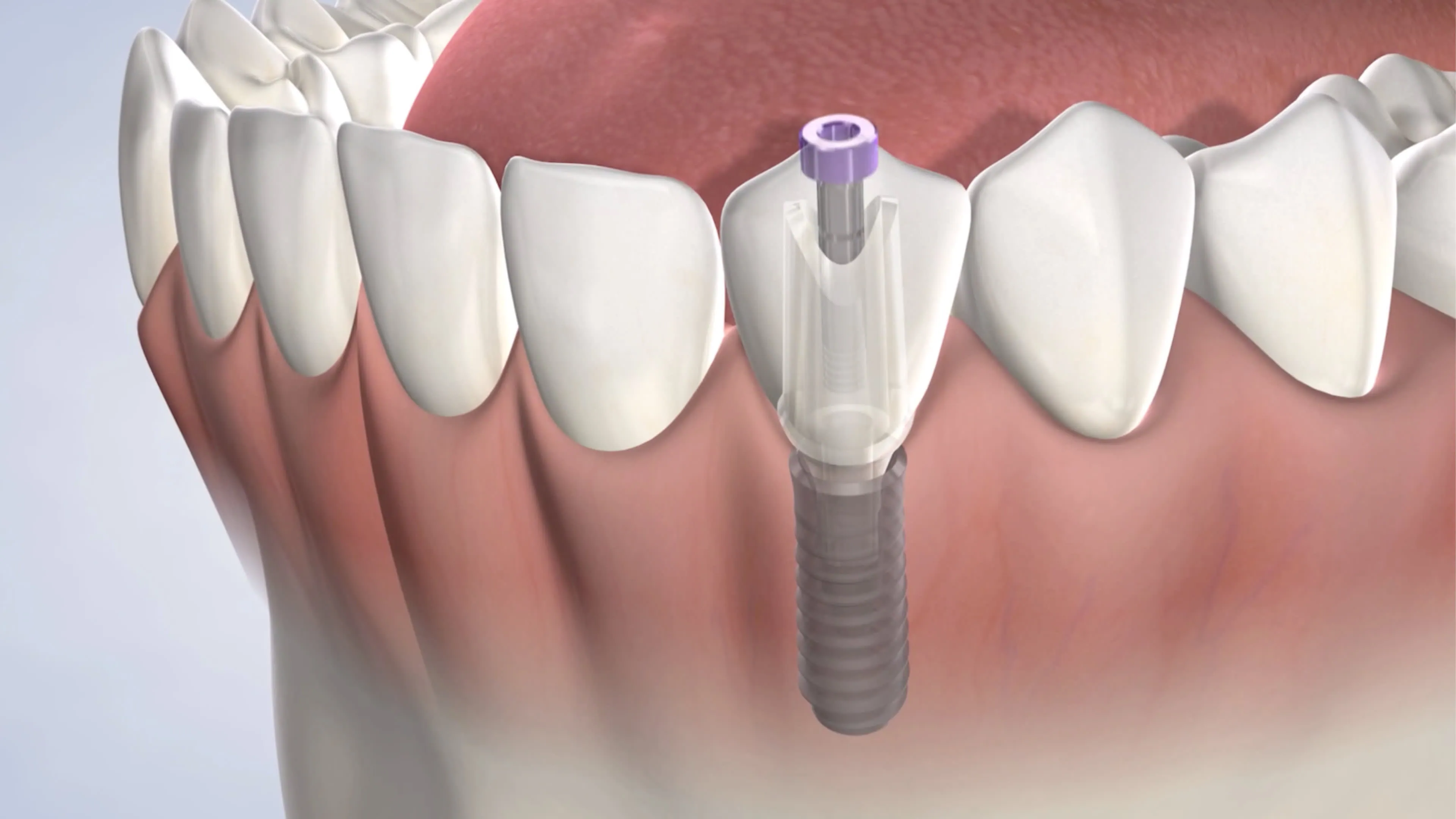 Dental implant post-operative instructions