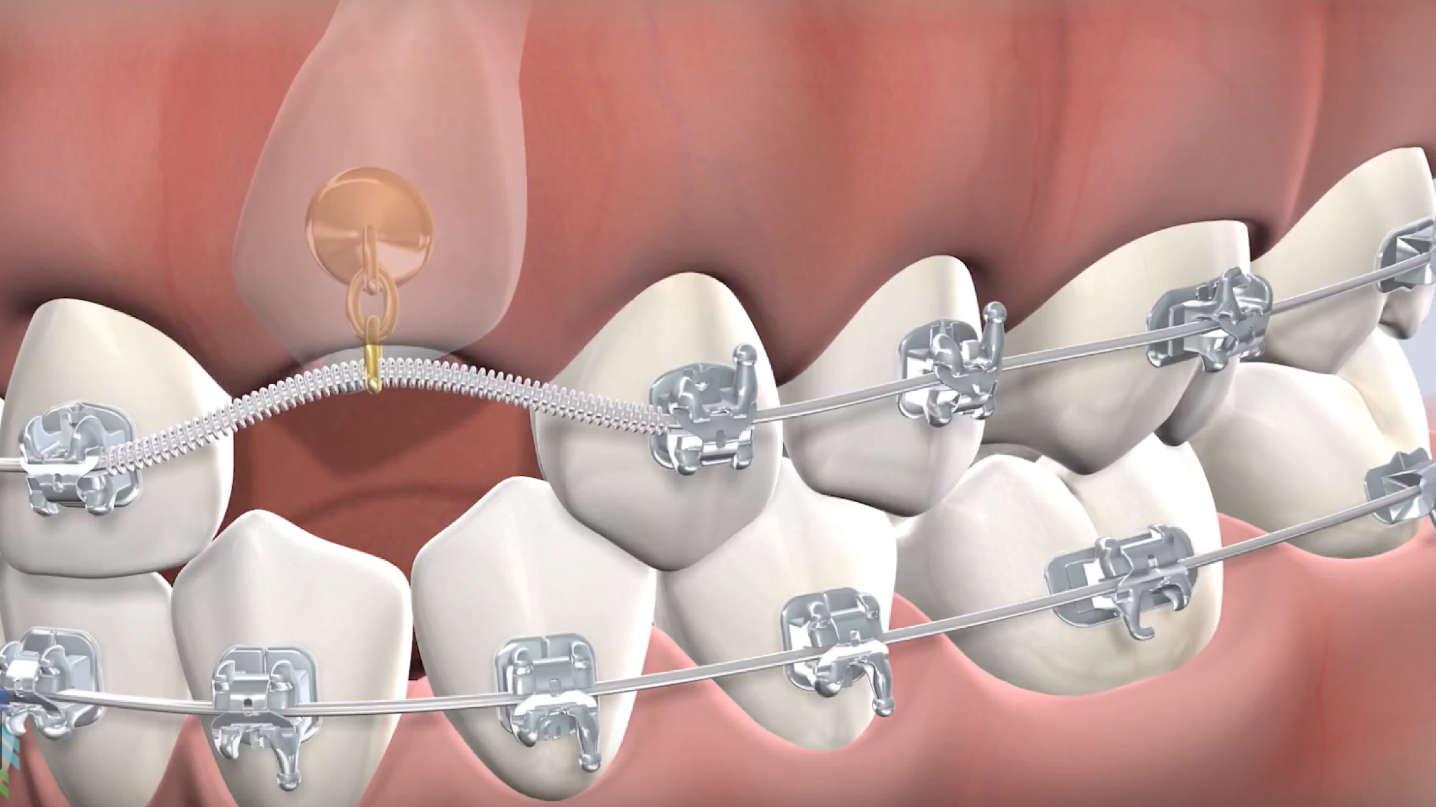 Instruction impacted tooth exposure