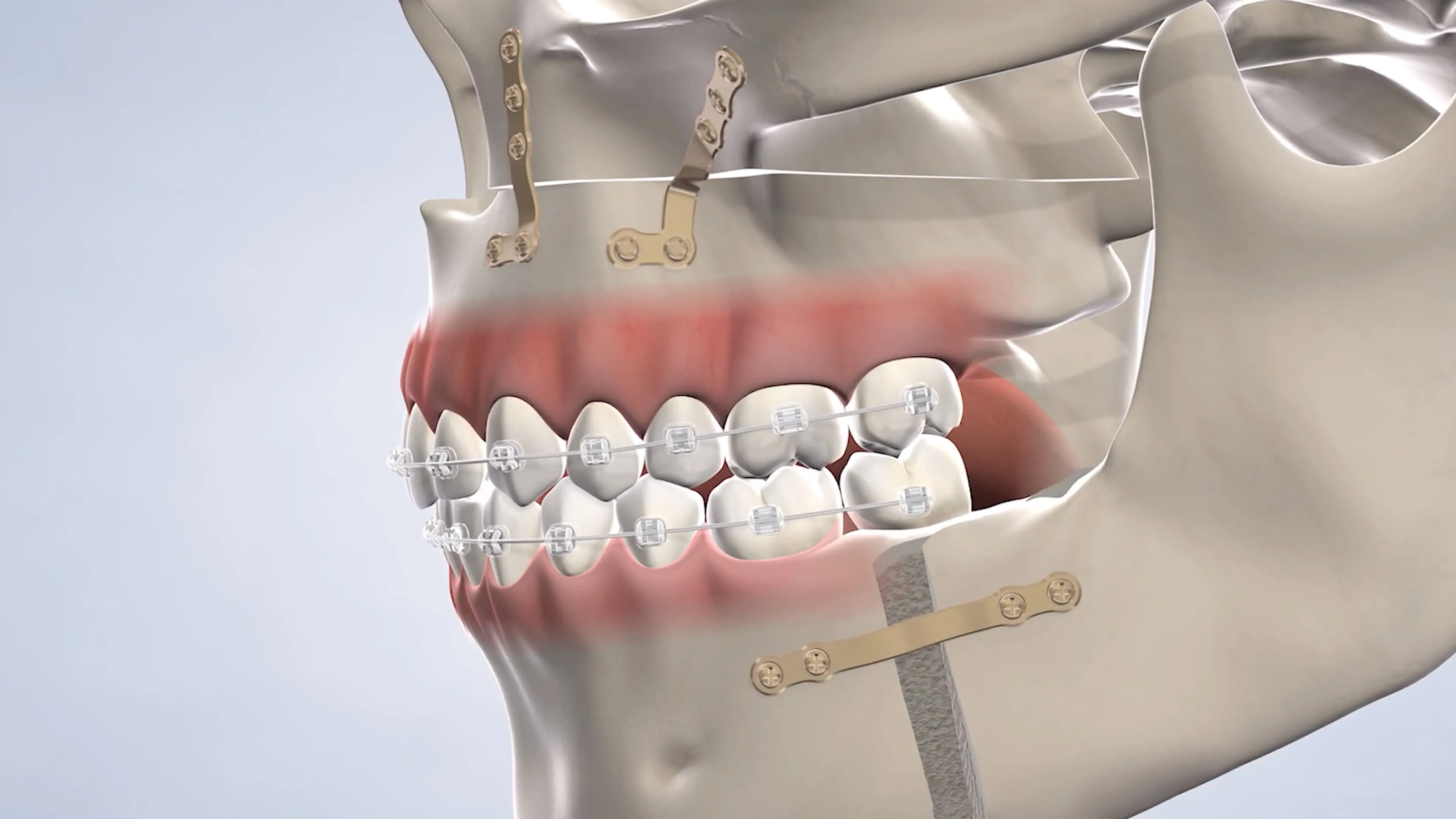 Jaw surgery post-operative instructions