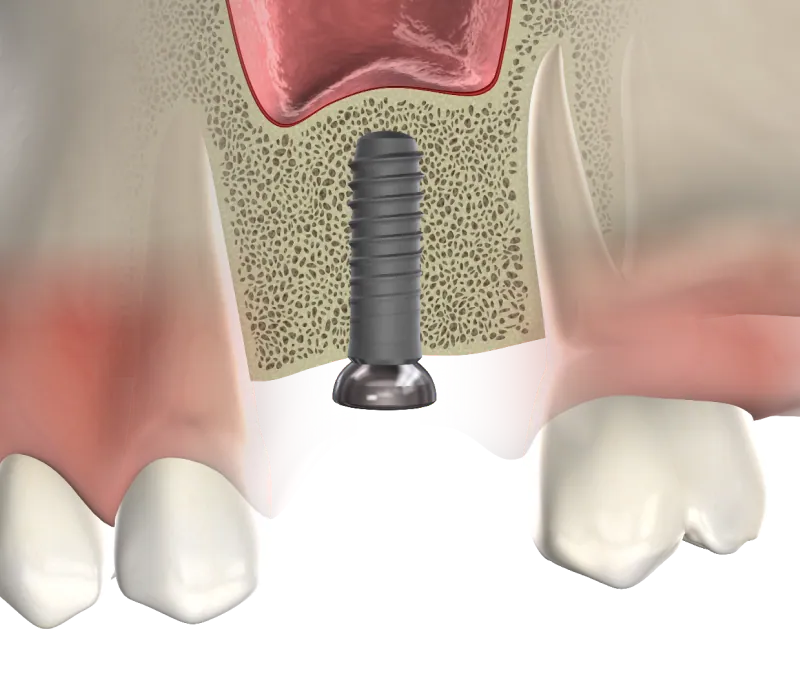 3D illustration of a dental implant placed in grafted jawbone