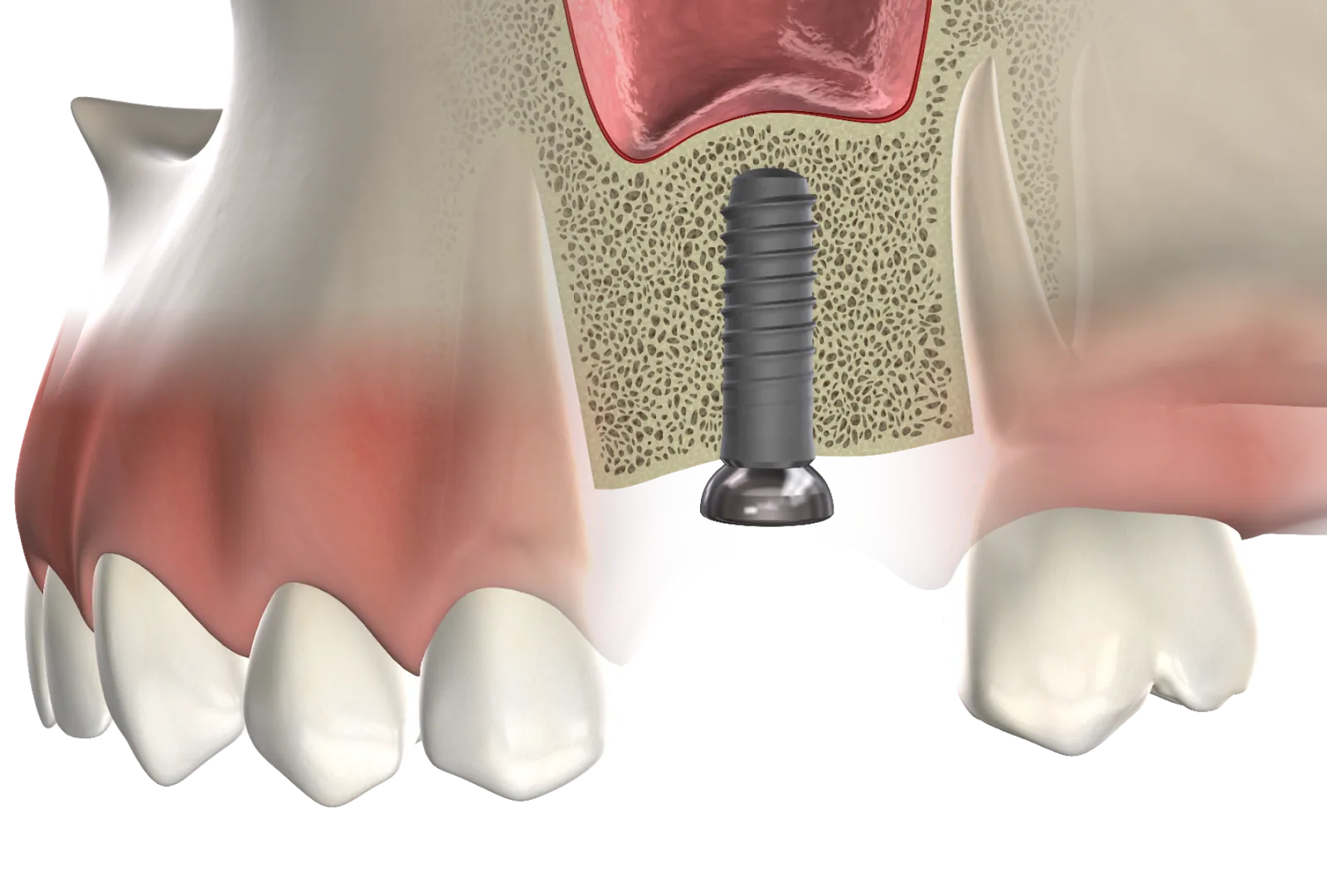 3D illustration of a dental implant placed in grafted jawbone