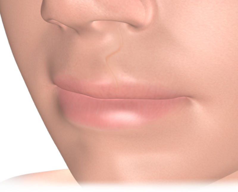 Isolated cleft lip palate repair mobile