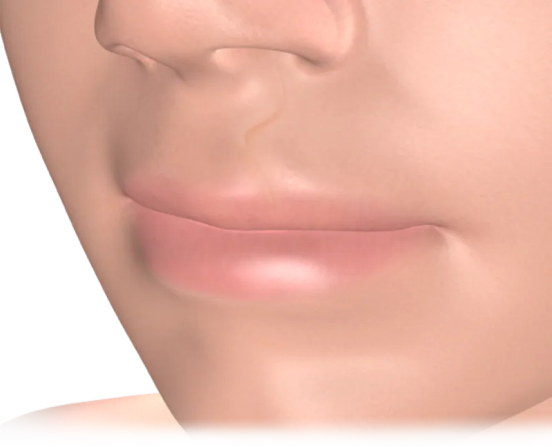 3D illustration of the upper lip for cleft lip and palate repair