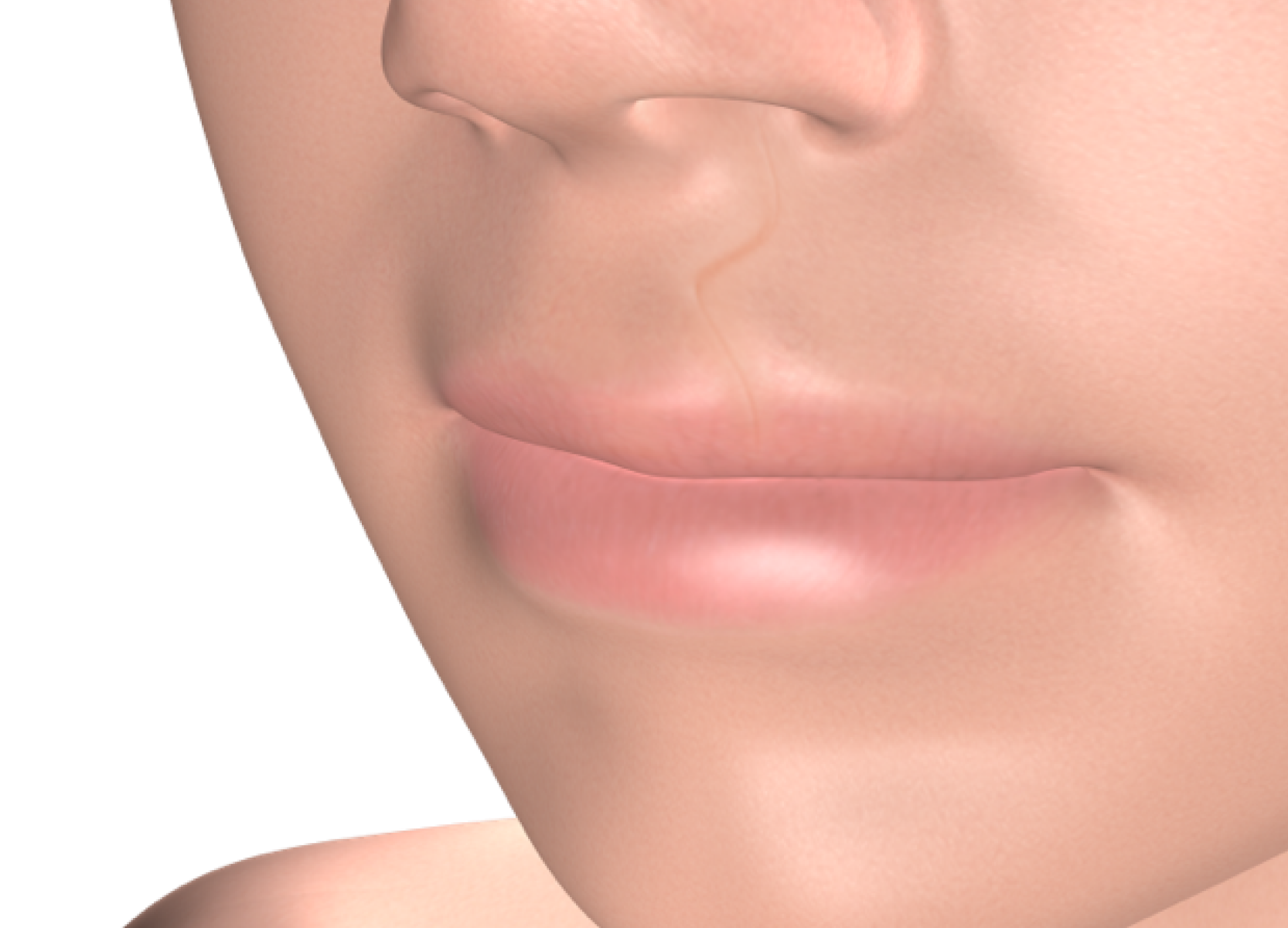 Isolated cleft lip palate repair
