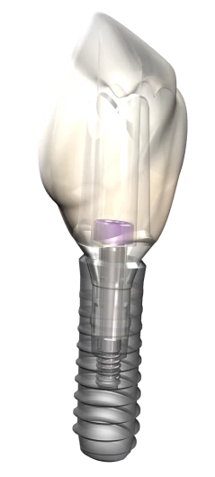 3D illustration of a dental implant with a crown