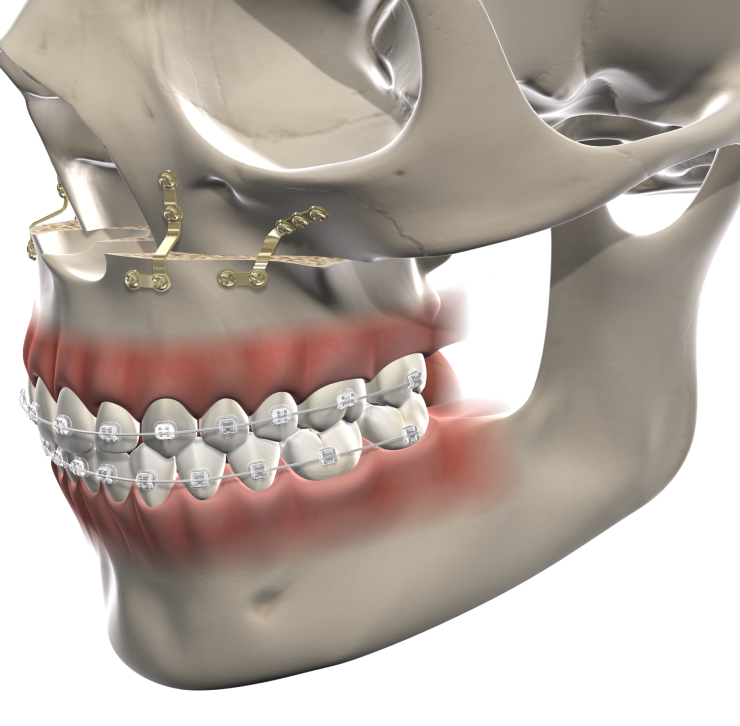 Isolated facial trauma mobile