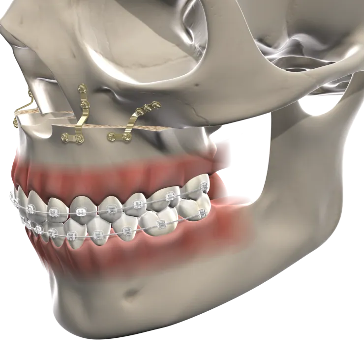3D illustration of facial bones and jaw with fixation hardware