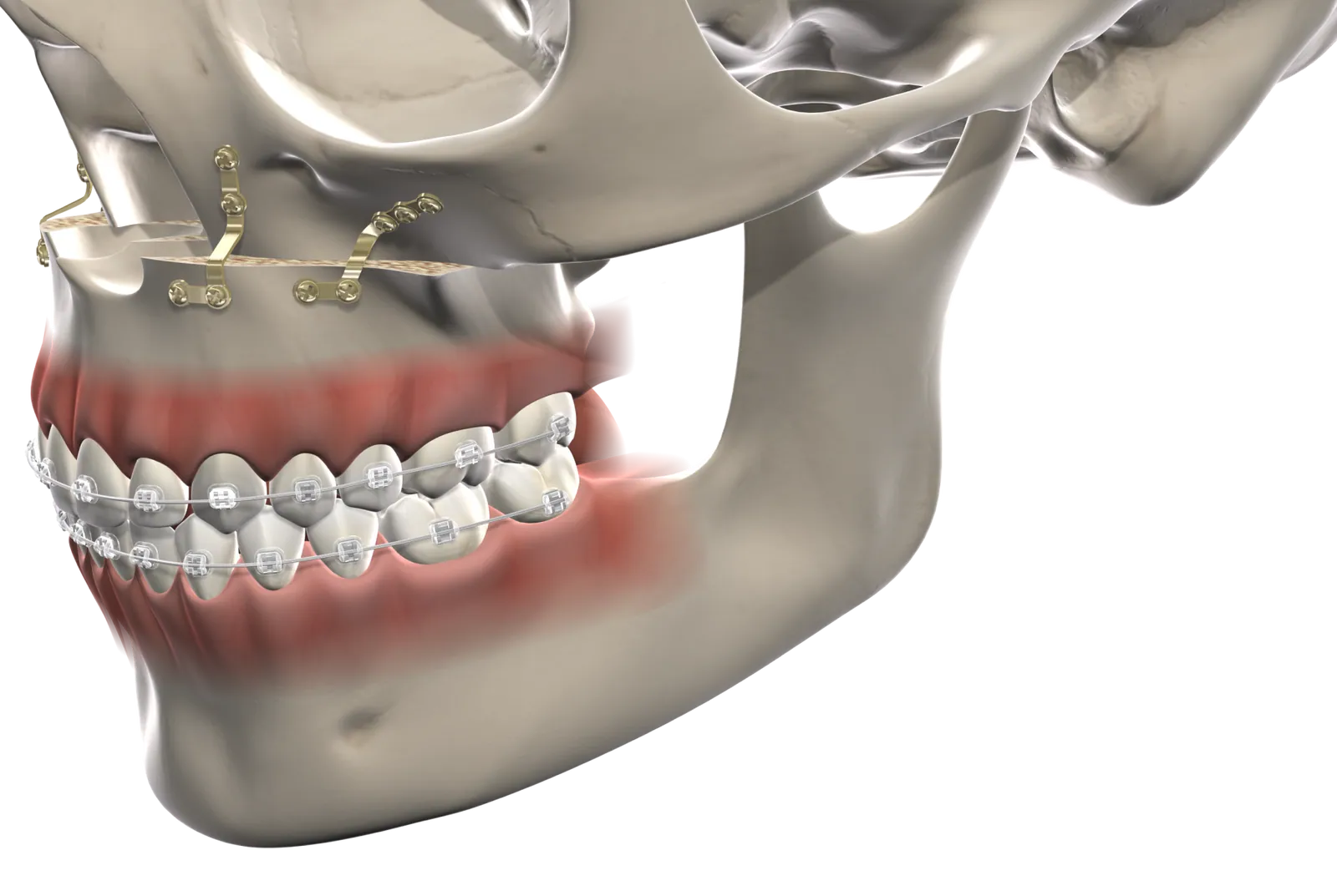 3D illustration of facial bones and jaw with fixation hardware