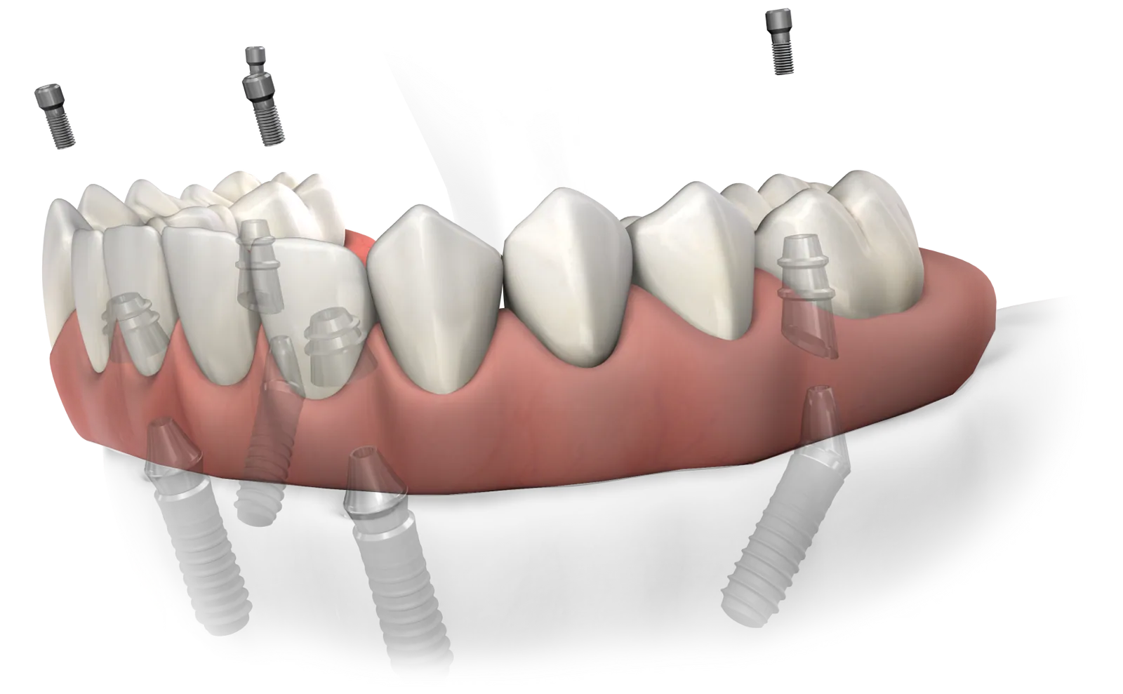 3D illustration of a full-arch bridge supported by dental implants