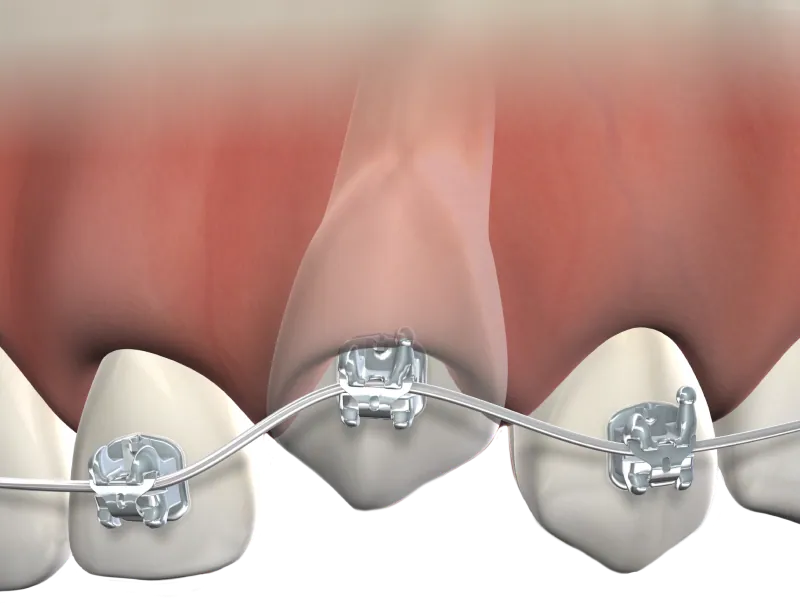 3D illustration of an impacted canine between teeth with braces