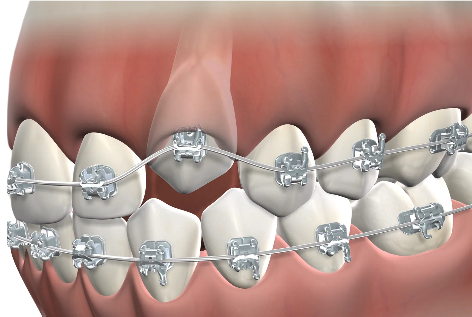 3D illustration of an impacted canine between teeth with braces