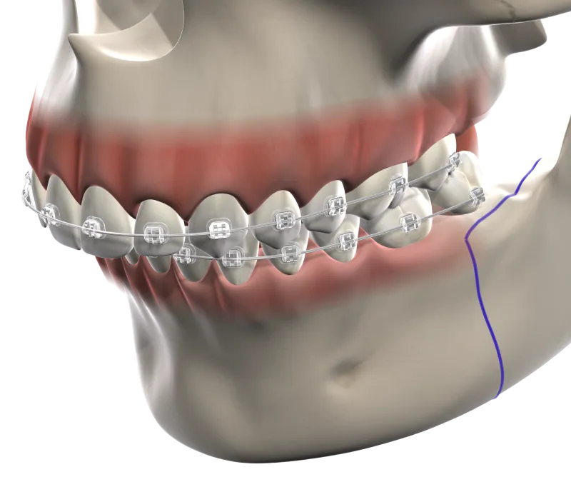 3D illustration of a jaw with braces and surgical cut lines marked