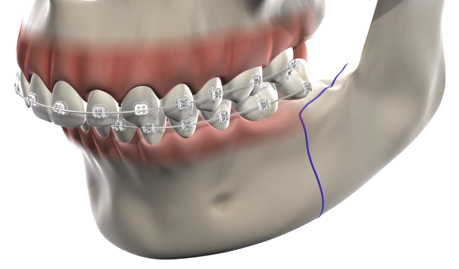 3D illustration of a jaw with braces and surgical cut lines marked