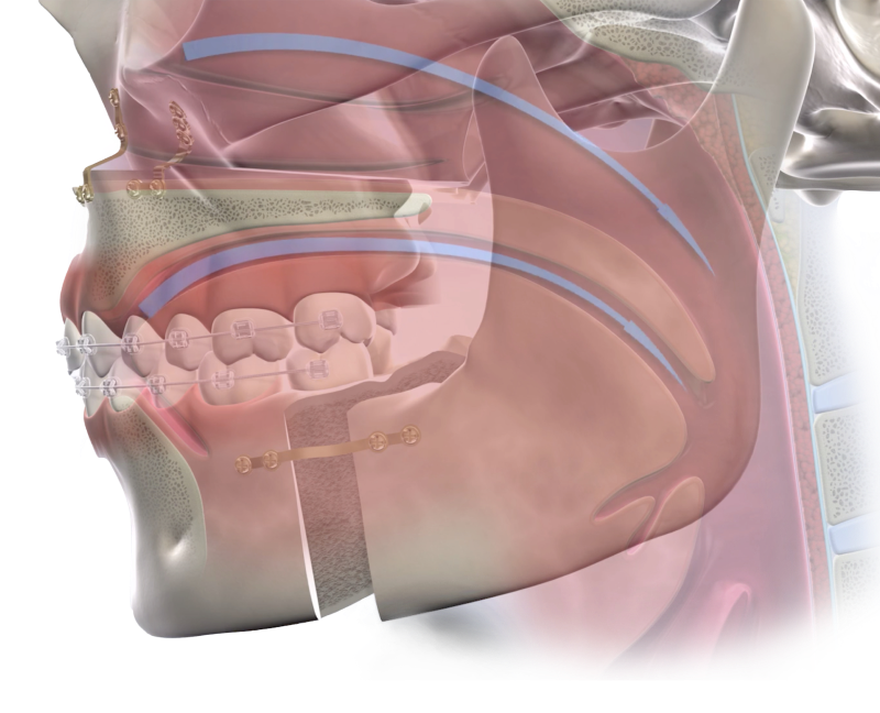 Isolated obstructive sleep apnea mobile
