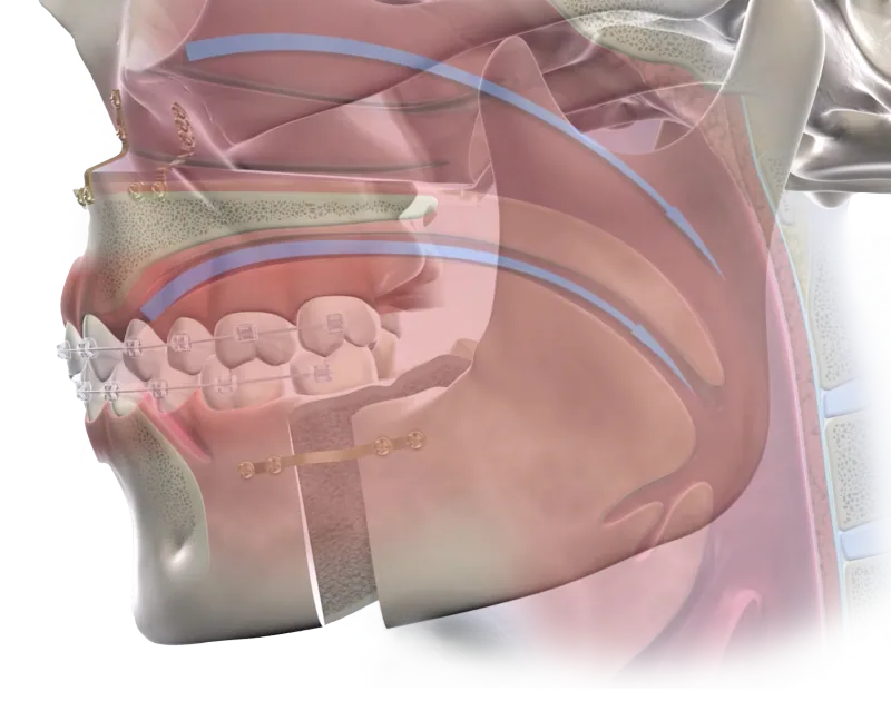 3D illustration of the airway and jaw in profile
