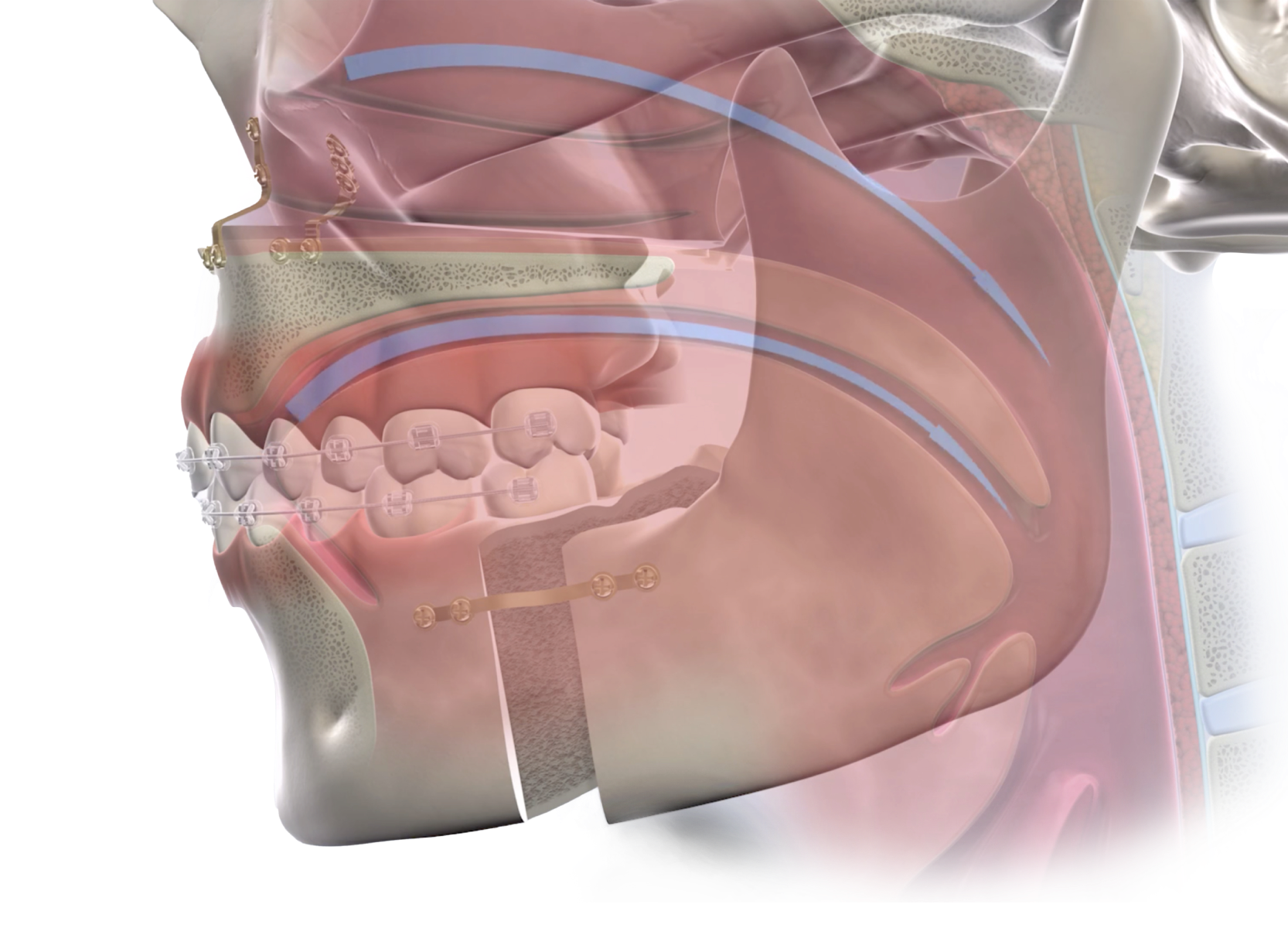 Isolated obstructive sleep apnea