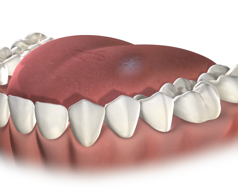 3D illustration of the palate with a small lesion