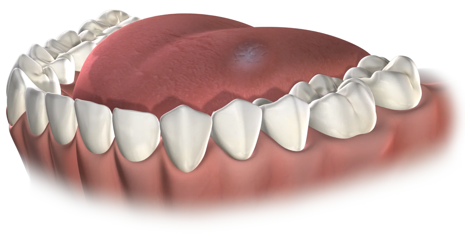 3D illustration of the palate with a small lesion