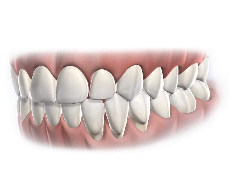 3D illustration of upper and lower teeth and gums