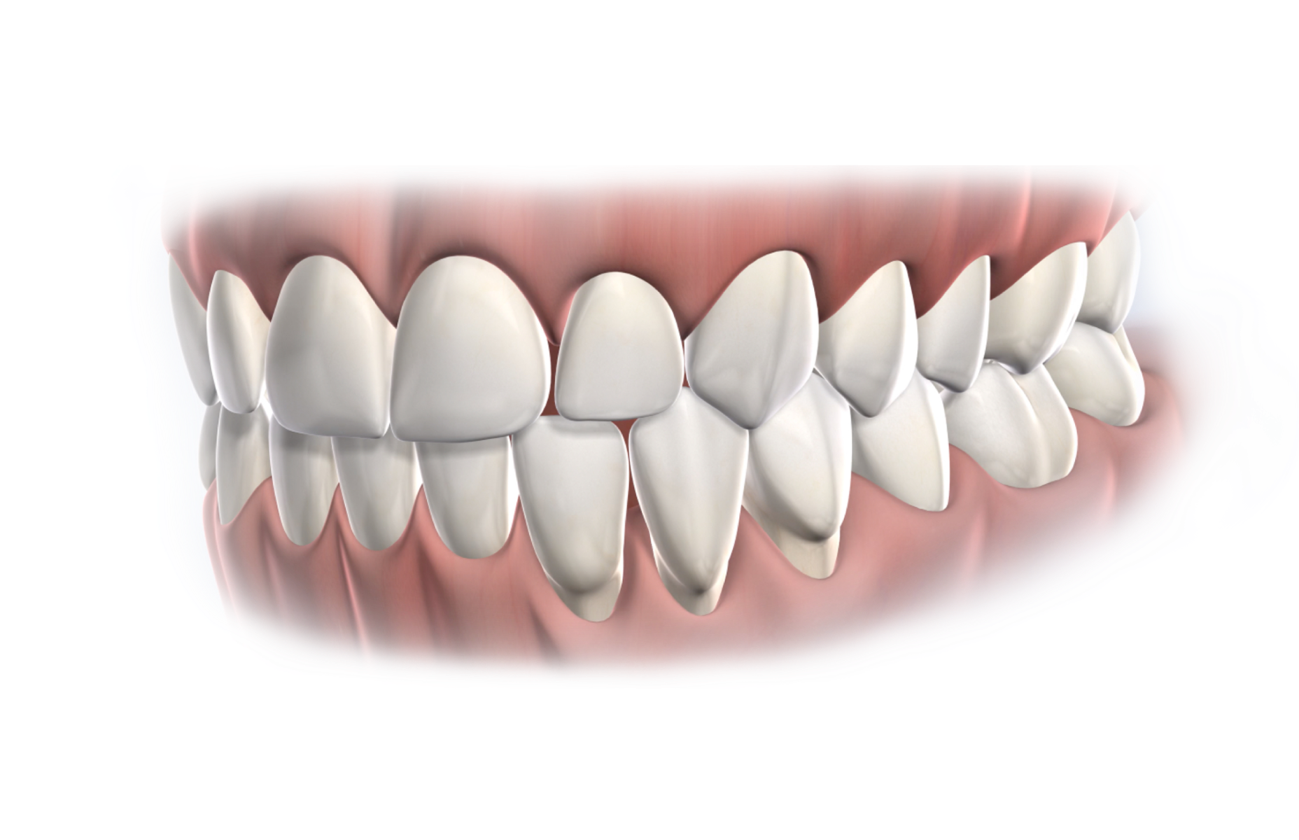 Isolated  periodontal pocket surgery