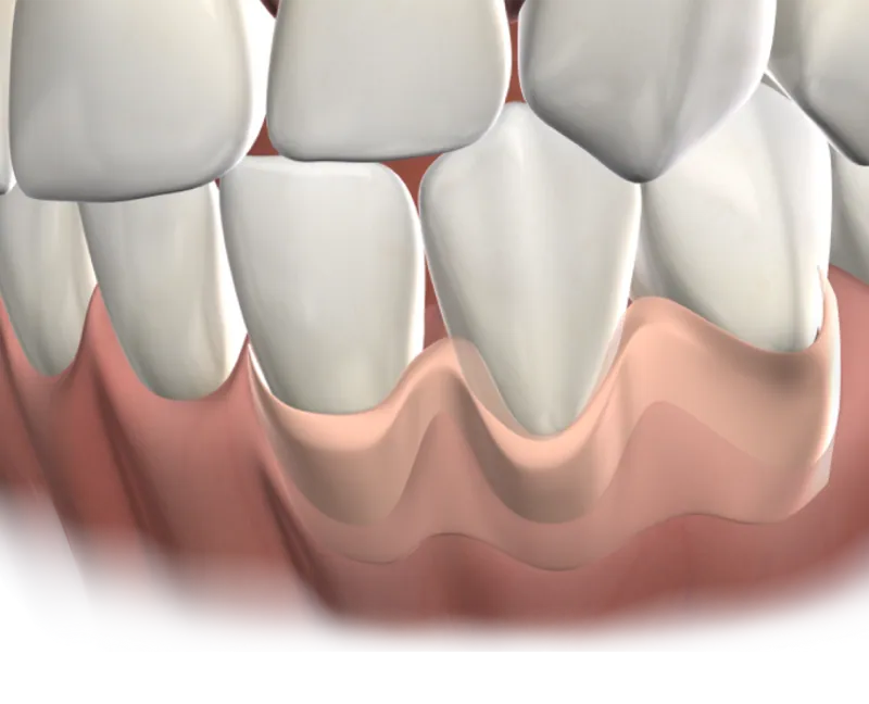 3D illustration of teeth with gum recession