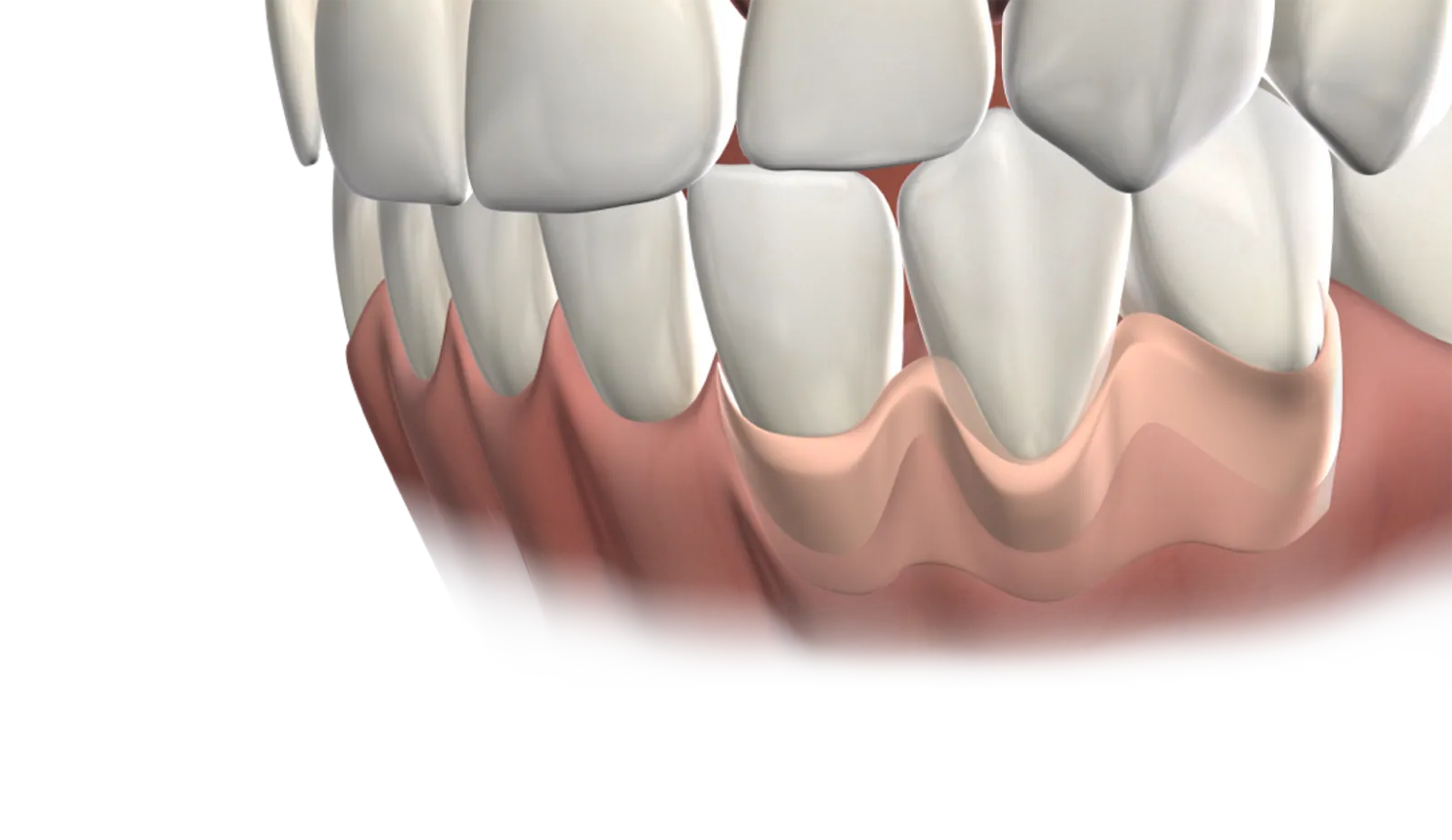 3D illustration of teeth with gum recession