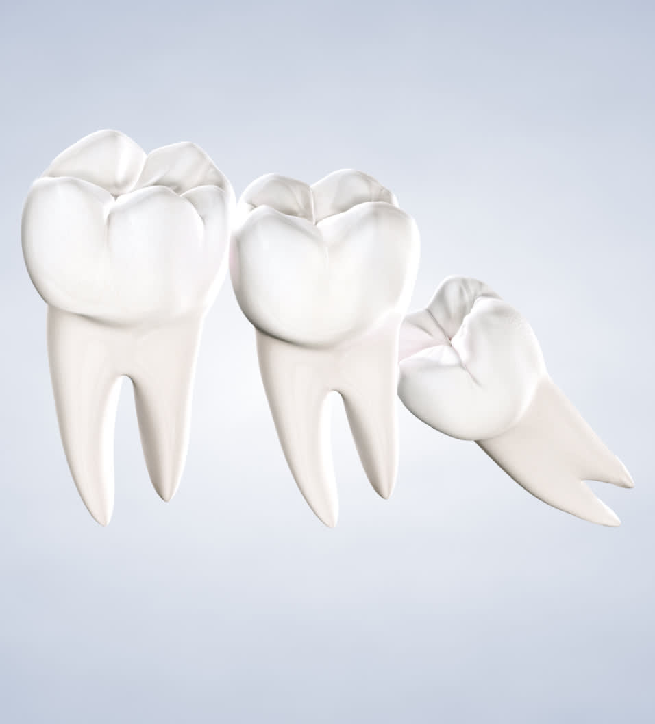 Query wisdom teeth removal