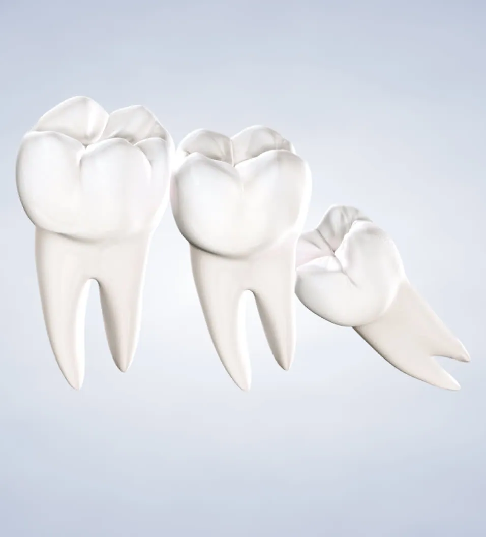 3D illustration of molars and a wisdom tooth