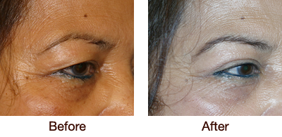 Blepharoplasty (Eyelid Surgery) Before & After Photo