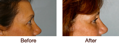 Blepharoplasty (Eyelid Surgery) Before & After Photo