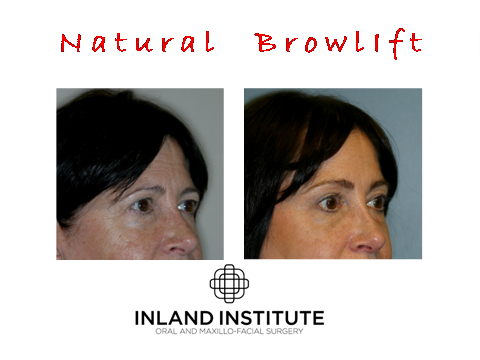 Browlift before and after