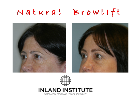 Browlift before and after