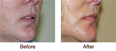 Before & After - Botox Filler