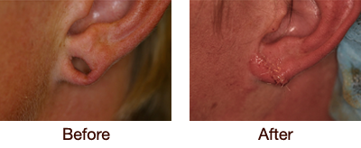 Otoplasty (Ear Surgery) Before & After - Stretched Lobe Repair