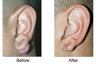 Otoplasty (Ear Surgery) Before & After - Lobe Keloid