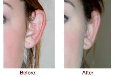 Otoplasty (Ear Surgery) Before & After